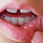 mouth ulcer