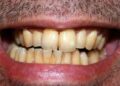 remove tobacco strain from tooth