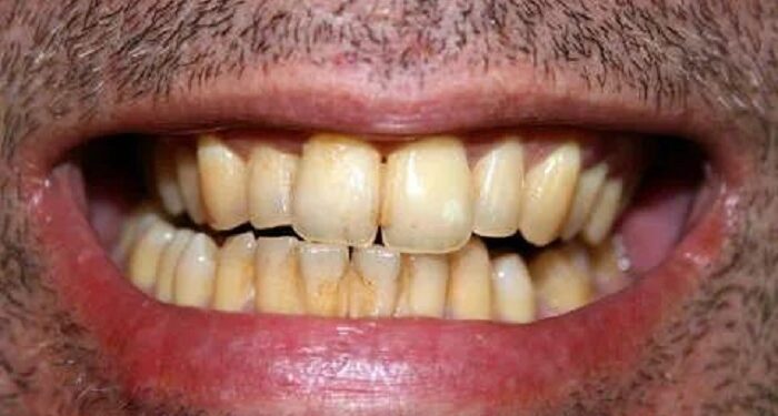 remove tobacco strain from tooth
