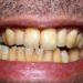 remove tobacco strain from tooth