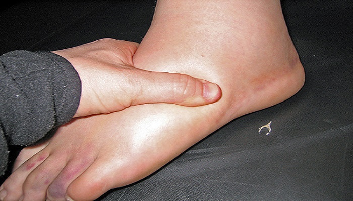 swelling of the feet