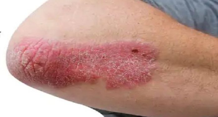 Psoriasis