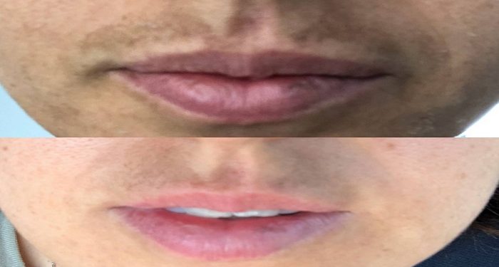 upperlip pigmentation