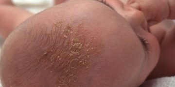 cradle cap