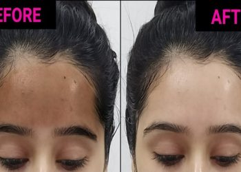 black forehead