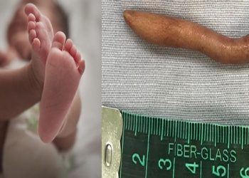 Baby girl born with 6 cm tail