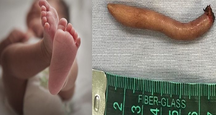 Baby girl born with 6 cm tail