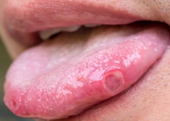 tongue blisters