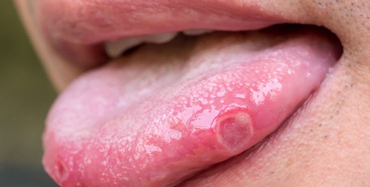 tongue blisters