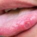 tongue blisters