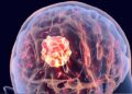 Brain Tumor