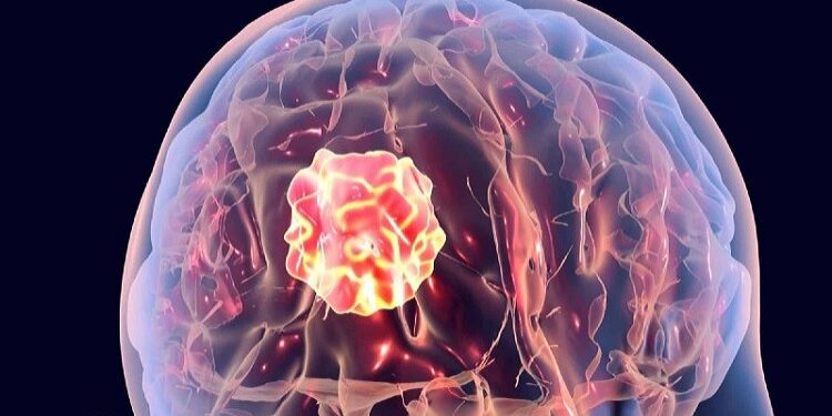 Brain Tumor