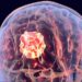 Brain Tumor