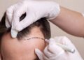 Hair Transplant