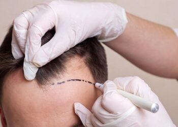 Hair Transplant