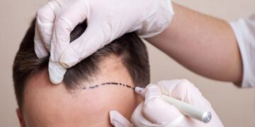 Hair Transplant