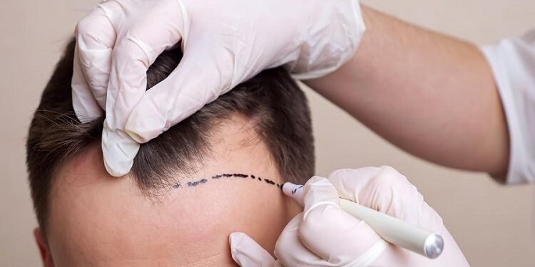Hair Transplant