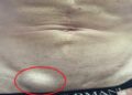 Hernia