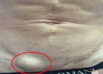 Hernia