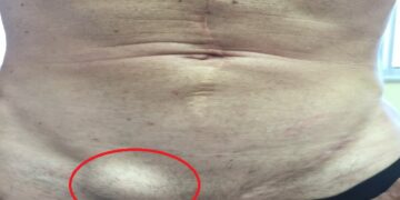 Hernia