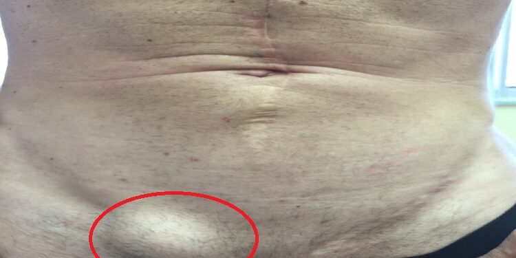 Hernia