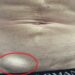 Hernia