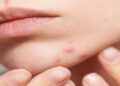 Pimple