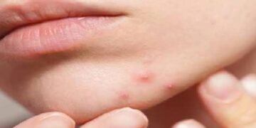 Pimple