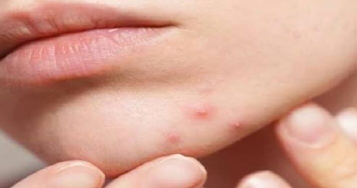 Pimple