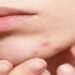 Pimple