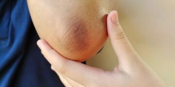 black elbow