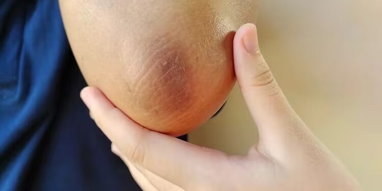 black elbow