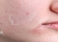 Dry Skin