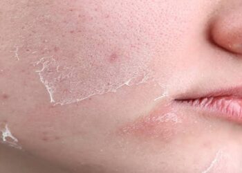 Dry Skin