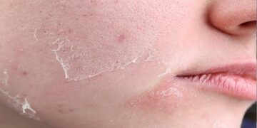 Dry Skin