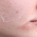 Dry Skin
