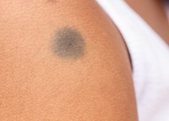 Birthmark