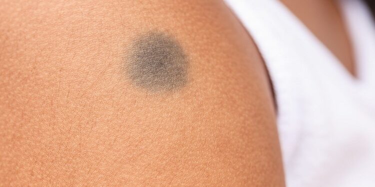 Birthmark
