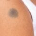 Birthmark