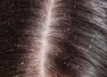 Dandruff