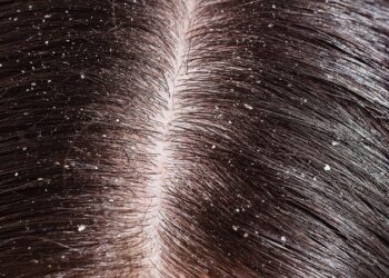 Dandruff