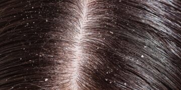 Dandruff