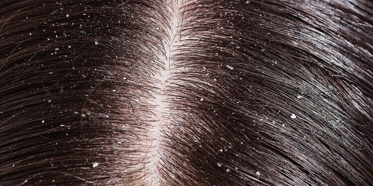 Dandruff