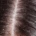 Dandruff