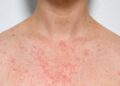 Heat Rash