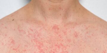 Heat Rash