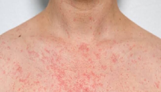 Heat Rash