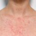 Heat Rash