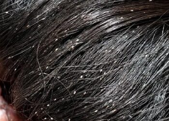 Lice