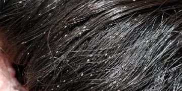 Lice